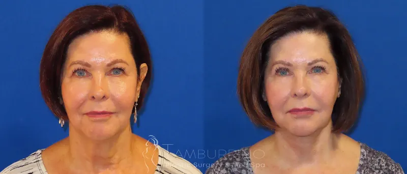 Before and after — Dr. Joseph Tamburrino