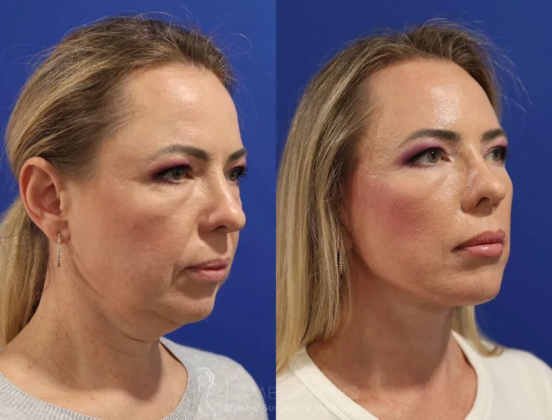 Before and after — Dr. Joseph Tamburrino