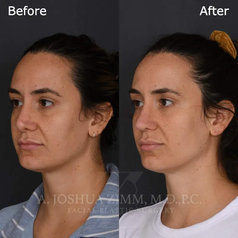 Before and after deep plane facelift — 38-year-old woman, three-quarter view, 13mo post-op by Dr. Joshua Zimm