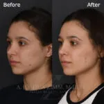 Before and after deep plane facelift — 20-year-old woman, left profile view, 6mo post-op by Dr. Joshua Zimm