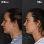 Before and after deep plane facelift — 30-year-old woman, left profile view, 7mo post-op by Dr. Joshua Zimm