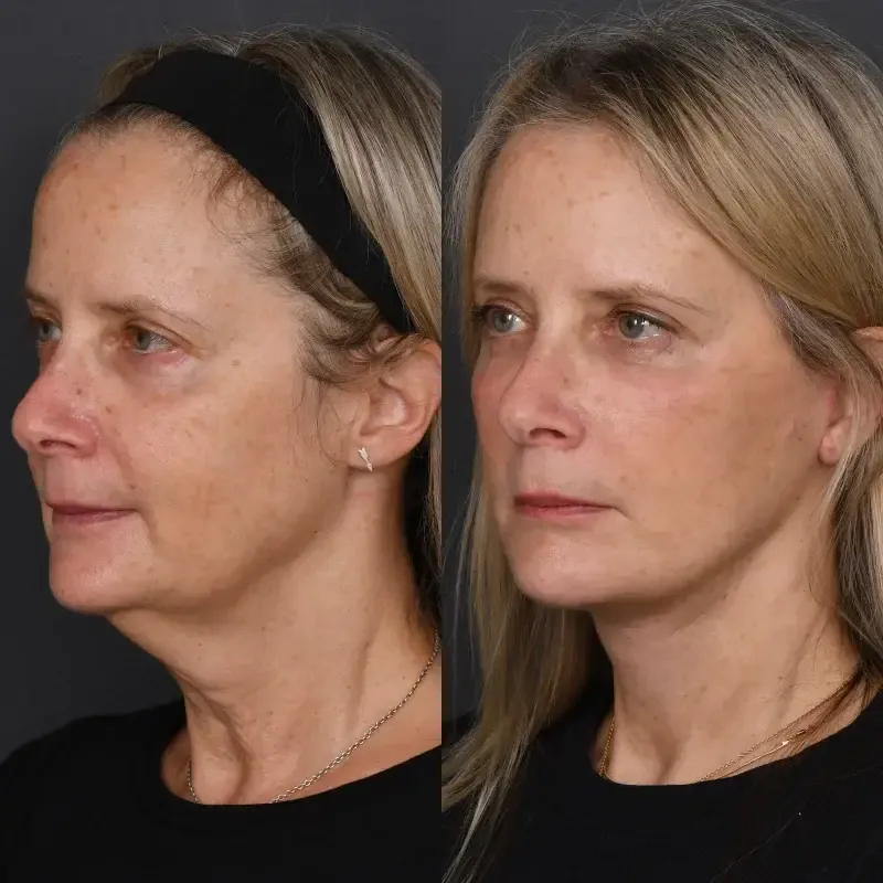 Before and after deep plane facelift — 50-year-old woman, three-quarter view, 9mo post-op by Dr. Joshua Zimm