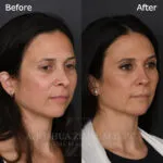 Before and after deep plane facelift — 45-year-old woman, oblique right view, 12mo post-op by Dr. Joshua Zimm