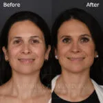 Before and after deep plane facelift — 50-year-old woman, frontal view, 7mo post-op by Dr. Joshua Zimm