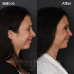 Before and after deep plane facelift — 40-year-old woman, left profile view, 8mo post-op by Dr. Joshua Zimm