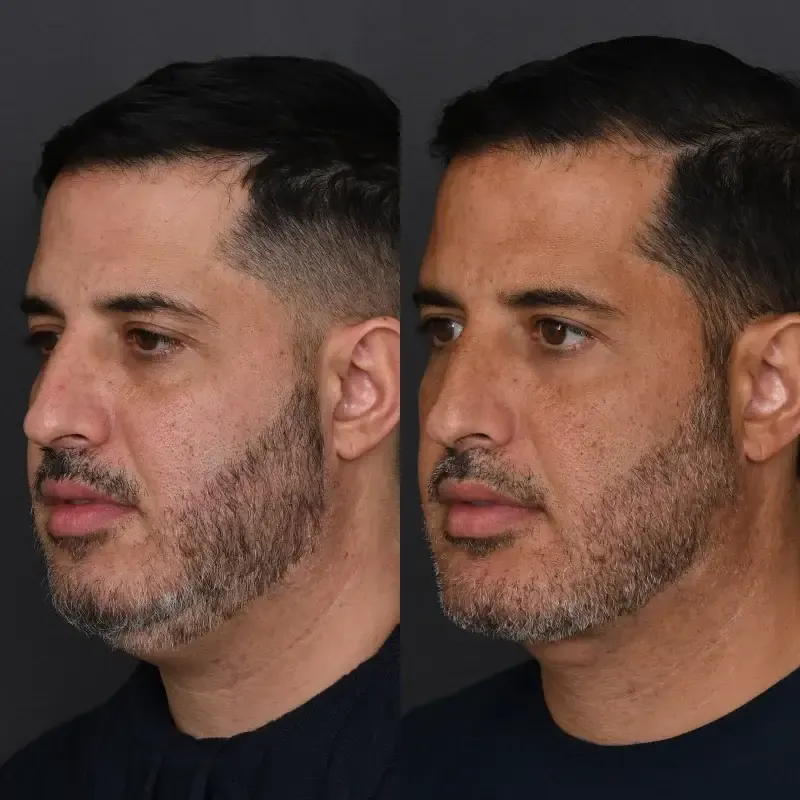 Before and after deep plane facelift — 45-year-old man, three-quarter view, 7mo post-op by Dr. Joshua Zimm