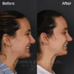 Before and after deep plane facelift — 35-year-old woman, left profile view, 7mo post-op by Dr. Joshua Zimm