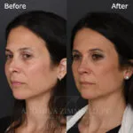 Before and after deep plane facelift — 50-year-old woman, three-quarter view, 13mo post-op by Dr. Joshua Zimm