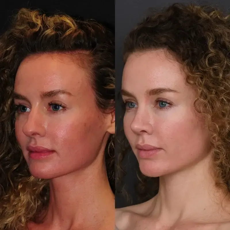 Before and after deep plane facelift — 40-year-old woman, three-quarter view, 12mo post-op by Dr. Joshua Zimm