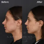 Before and after deep plane facelift — 25-year-old woman, left profile view, 12mo post-op by Dr. Joshua Zimm