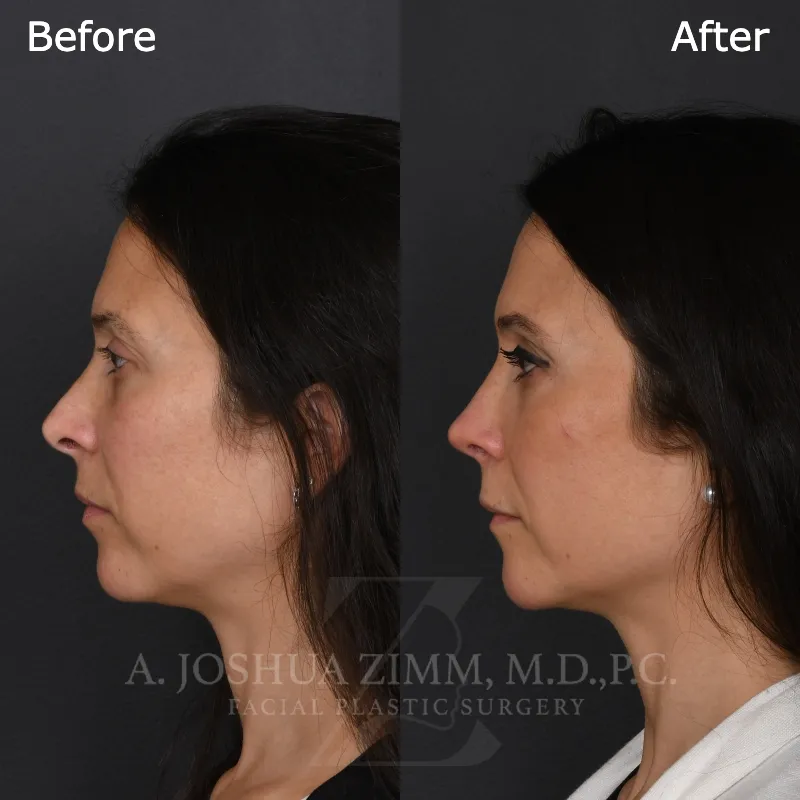 Before and after deep plane facelift — 50-year-old woman, left profile view, 13mo post-op by Dr. Joshua Zimm