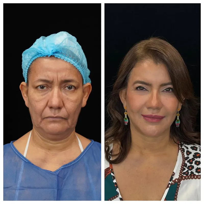 Before and after — Dr. JP Menendez