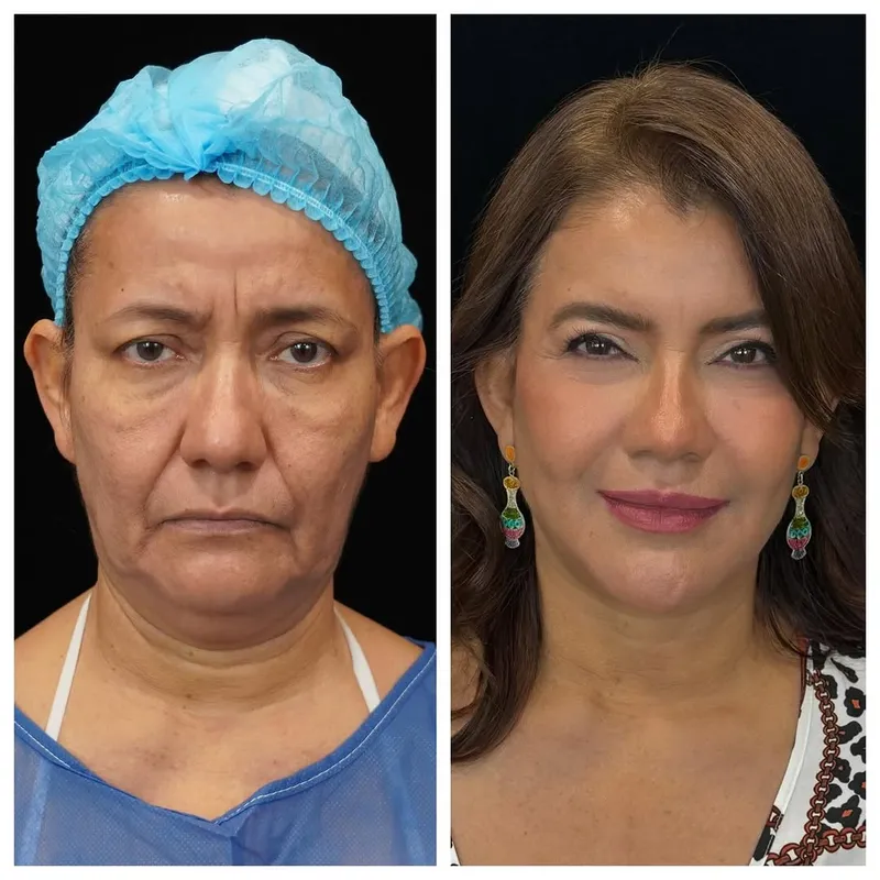 Before and after — Dr. JP Menendez