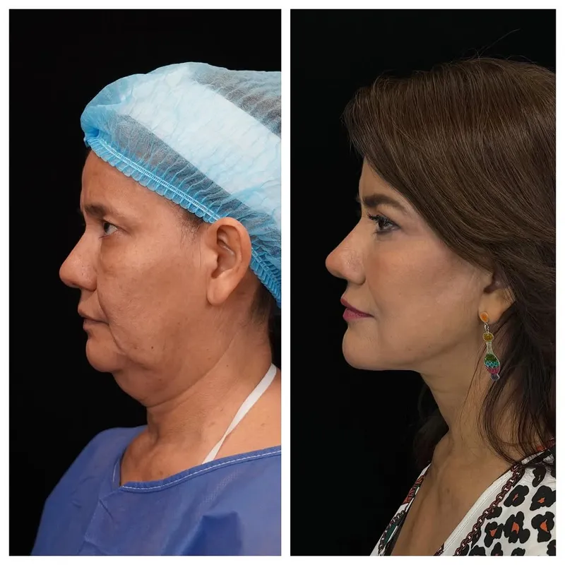 Before and after — Dr. JP Menendez