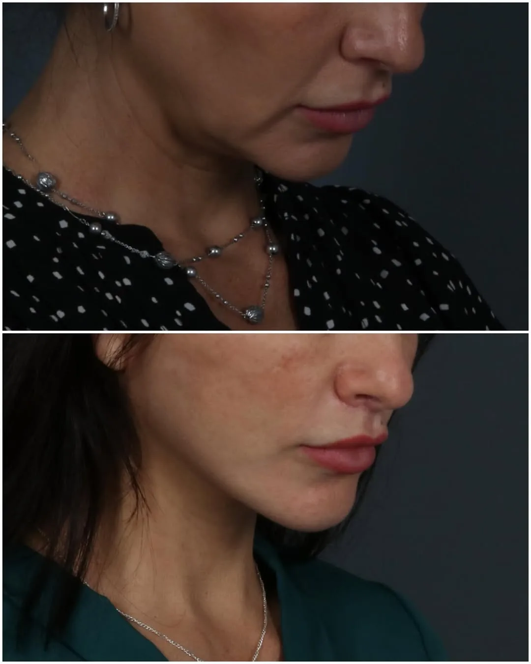 Before and after deep plane facelift — 45-year-old woman, three-quarter view, 5mo post-op by Dr. Juan Beltran