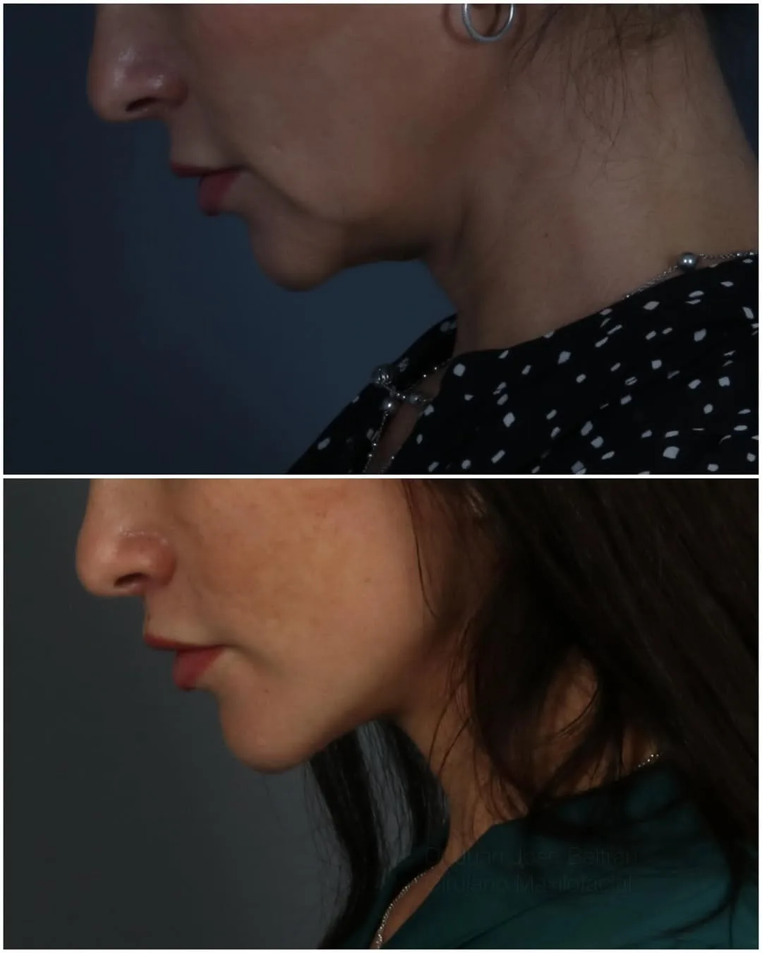 Before and after deep plane facelift — 45-year-old woman, three-quarter view, 5mo post-op by Dr. Juan Beltran