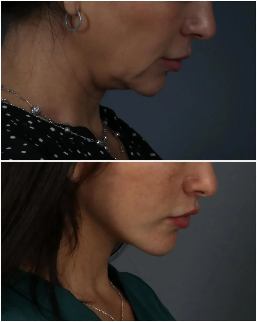 Before and after deep plane facelift — 45-year-old woman, three-quarter view, 5mo post-op by Dr. Juan Beltran