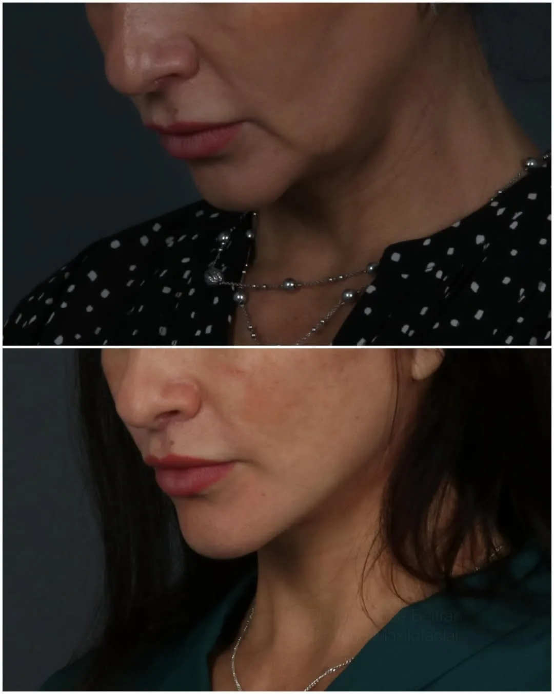 Before and after deep plane facelift — 45-year-old woman, three-quarter view, 5mo post-op by Dr. Juan Beltran