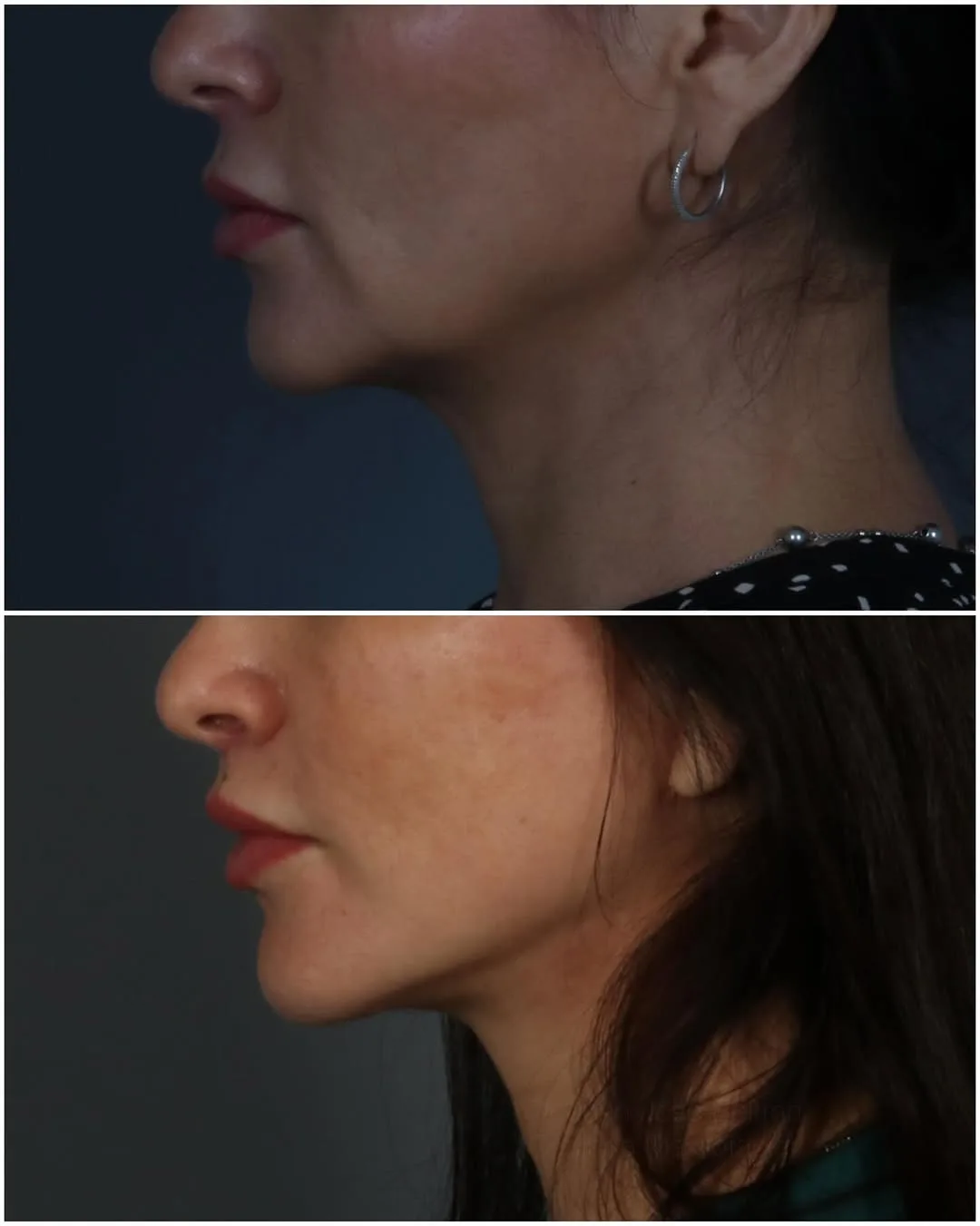 Before and after deep plane facelift — 45-year-old woman, three-quarter view, 5mo post-op by Dr. Juan Beltran