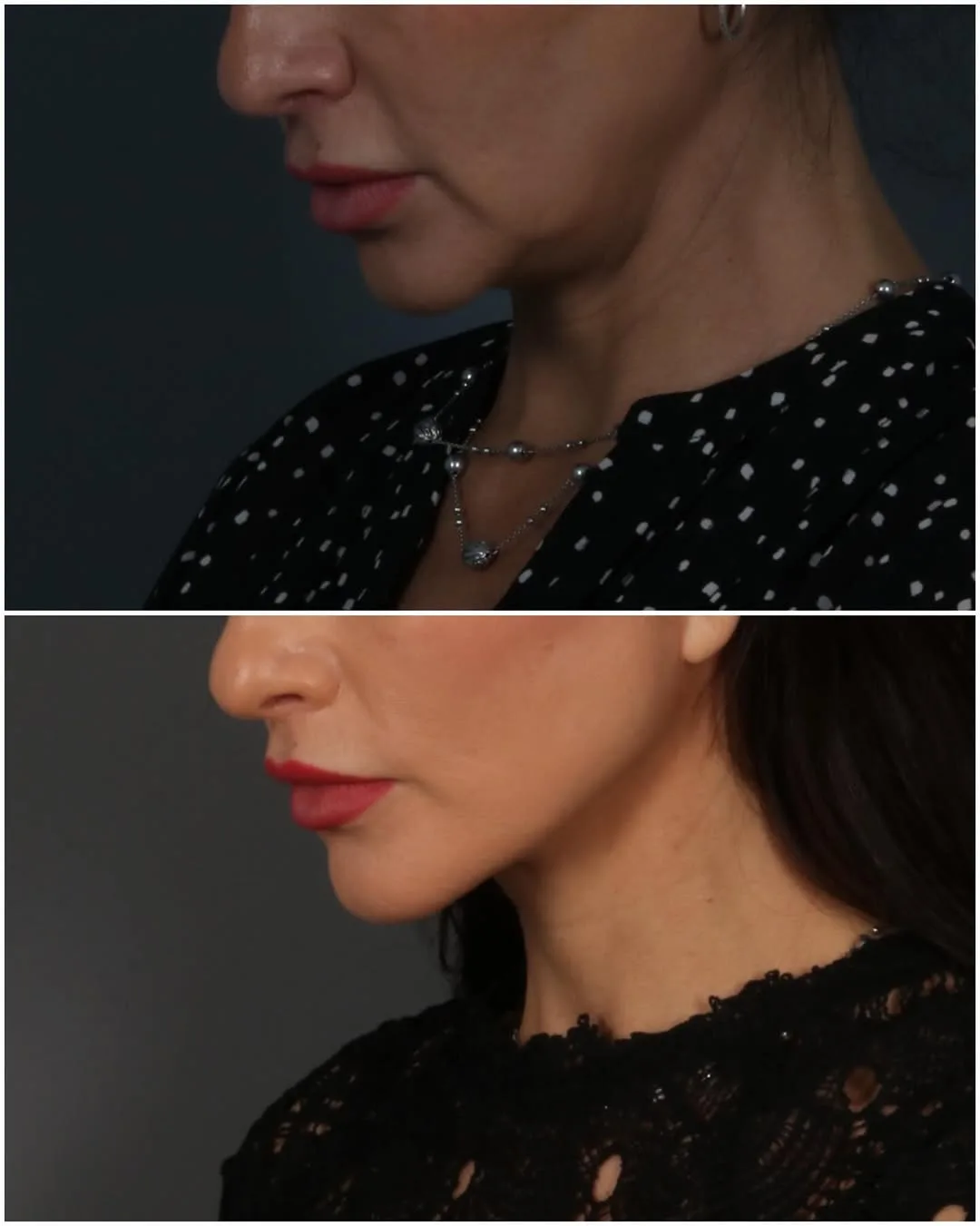 Before and after deep plane facelift — 35-year-old woman, three-quarter view, 3mo post-op by Dr. Juan Beltran