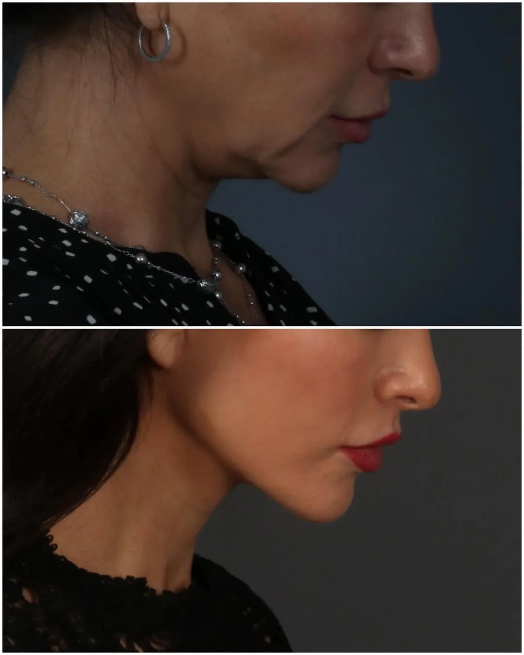 Before and after deep plane facelift — 35-year-old woman, three-quarter view, 3mo post-op by Dr. Juan Beltran