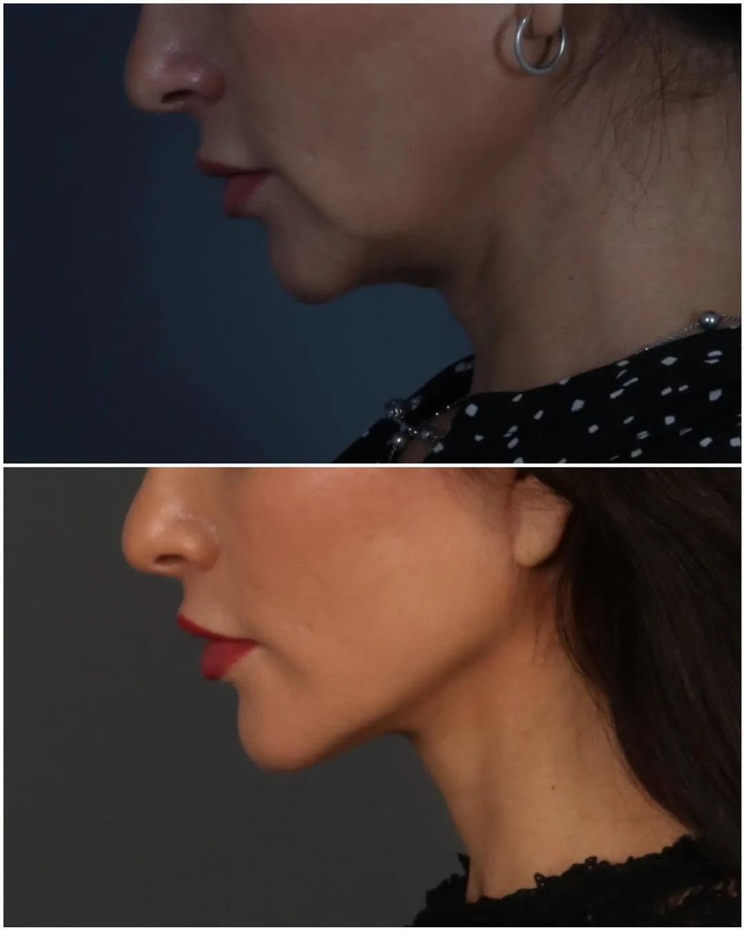 Before and after deep plane facelift — 28-year-old woman, three-quarter view, 3mo post-op by Dr. Juan Beltran