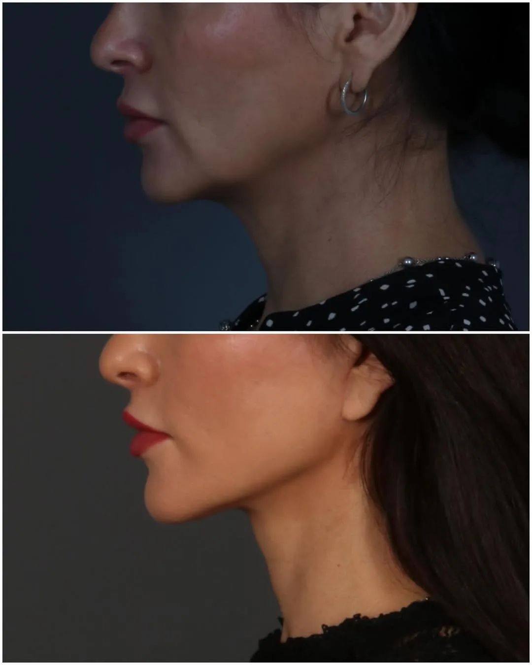 Before and after deep plane facelift — 42-year-old woman, three-quarter view, 3mo post-op by Dr. Juan Beltran