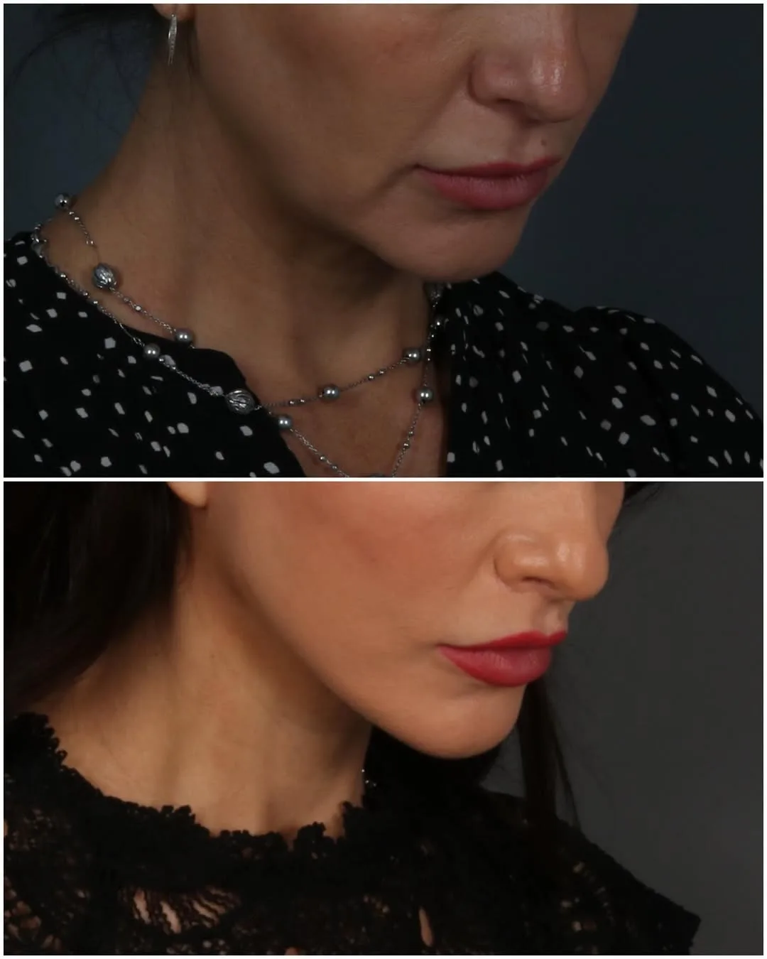 Before and after deep plane facelift — 28-year-old woman, three-quarter view, 3mo post-op by Dr. Juan Beltran
