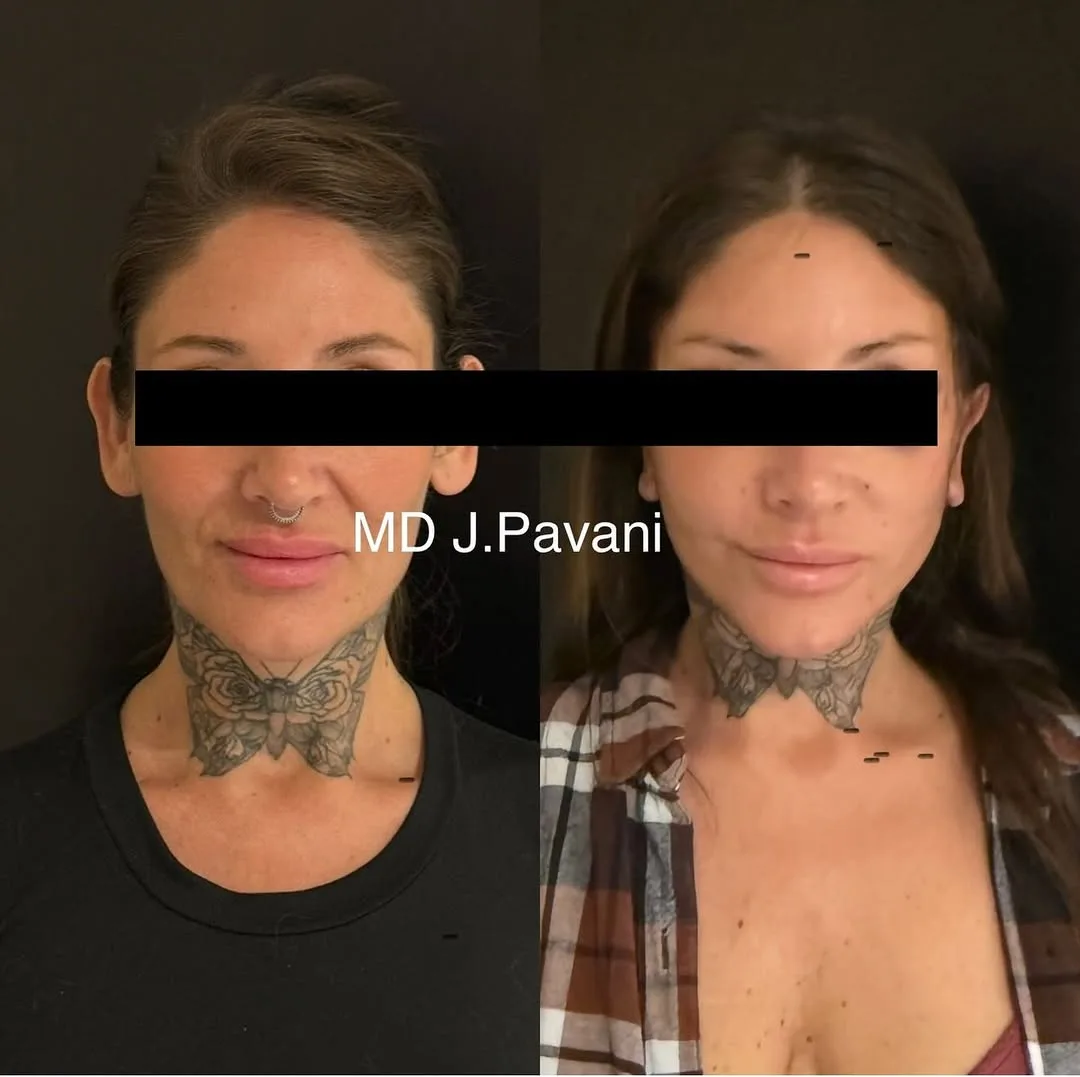 Before and after — Dr. Juan Pavani