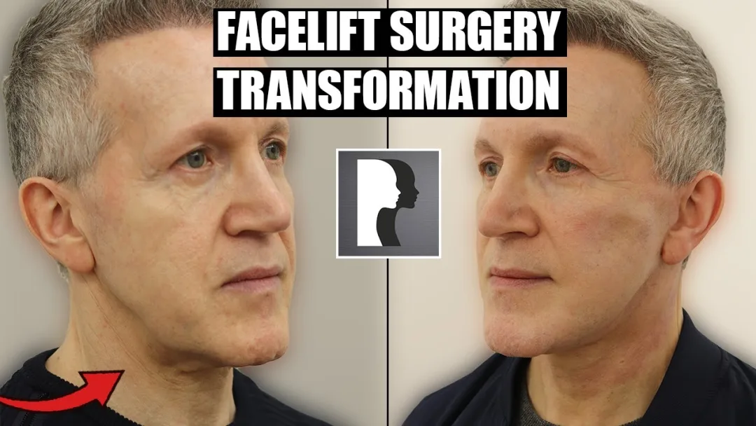 Before and after deep plane facelift — 55-year-old man, oblique right view, 6mo post-op by Dr. Julian De Silva