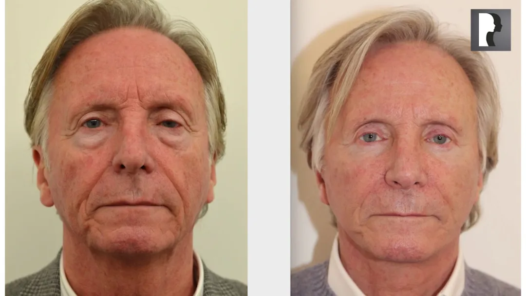 Before and after deep plane facelift — 65-year-old man, frontal view, 7mo post-op by Dr. Julian De Silva