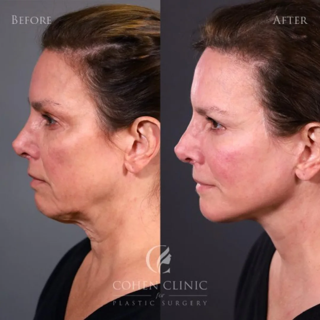 Before and after — Dr. Justin Cohen