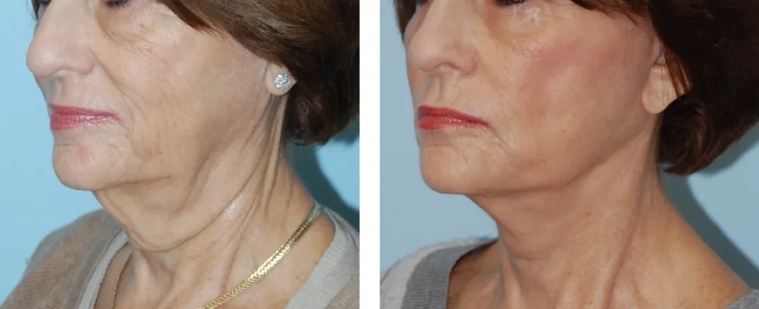 Before and after — Dr. Kapil Saigal