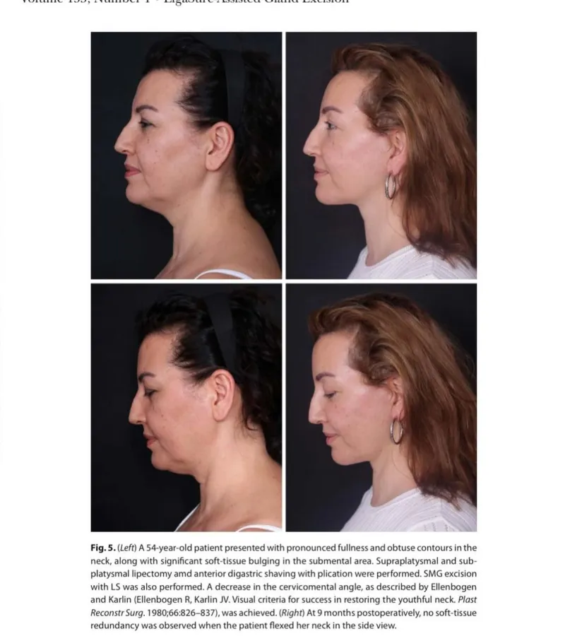 Before and after: Dr. Karaca Başaran