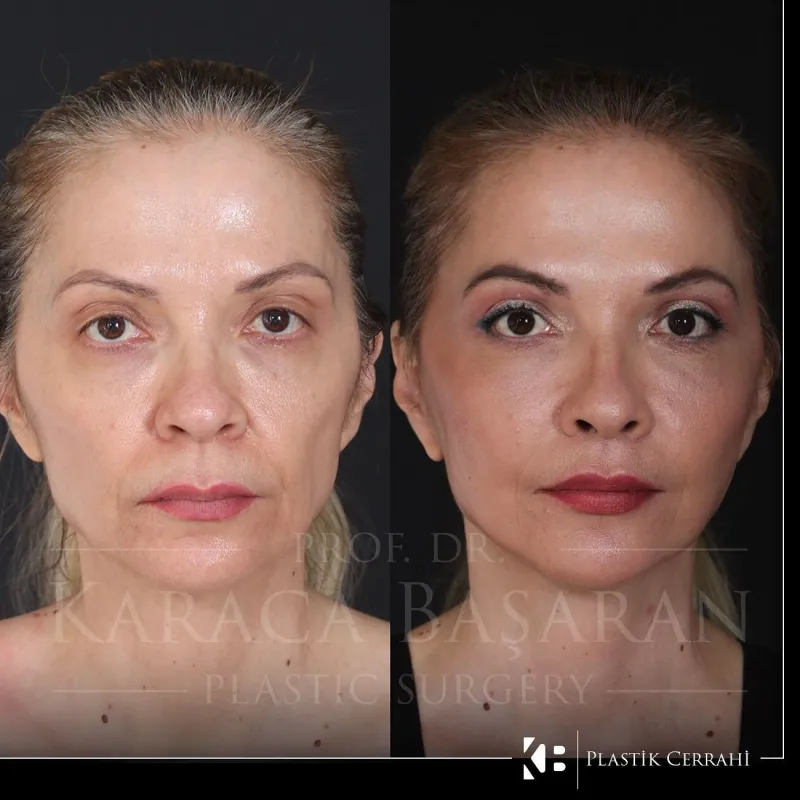Before and after: Dr. Karaca Başaran