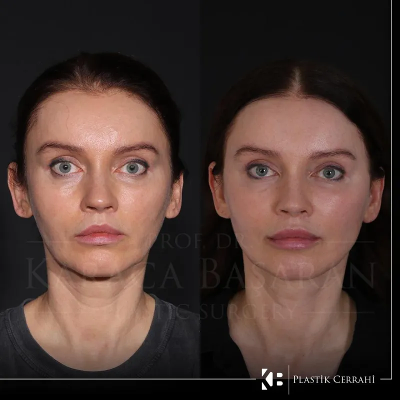 Before and after: Dr. Karaca Başaran