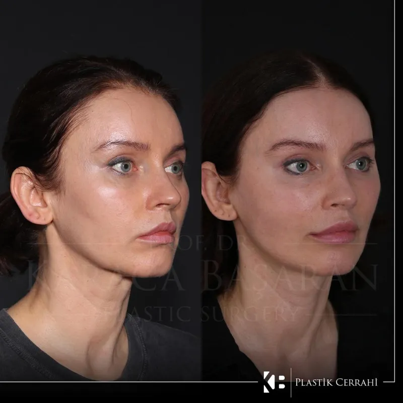 Before and after — Dr. Karaca Başaran