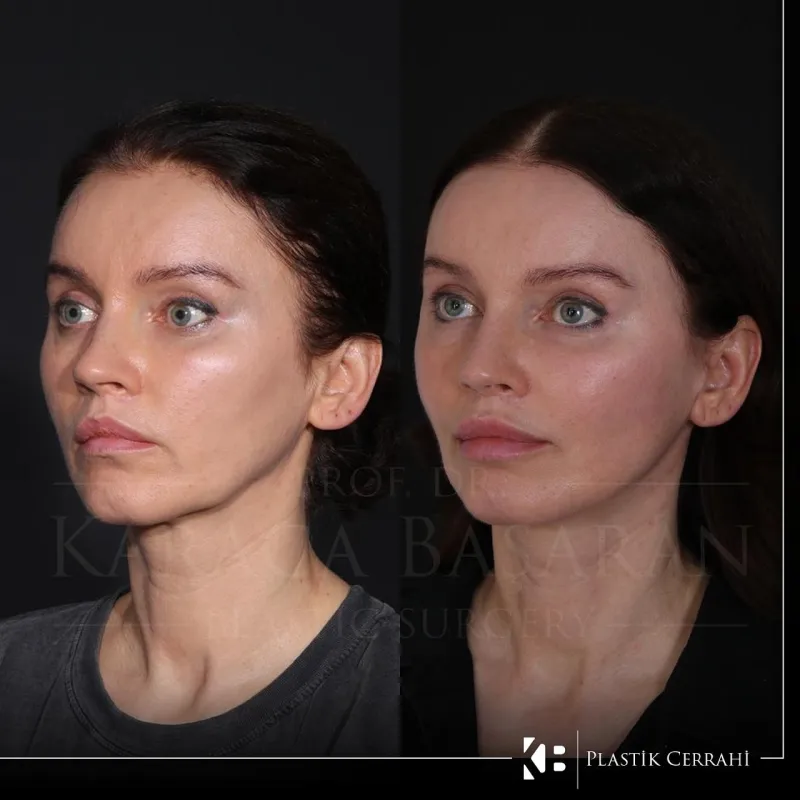 Before and after — Dr. Karaca Başaran