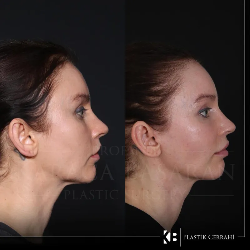 Before and after — Dr. Karaca Başaran