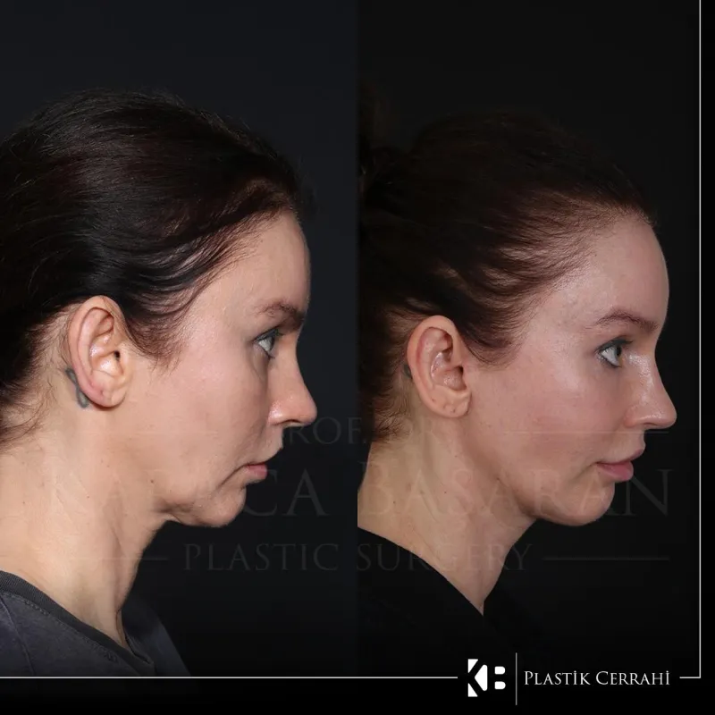 Before and after — Dr. Karaca Başaran
