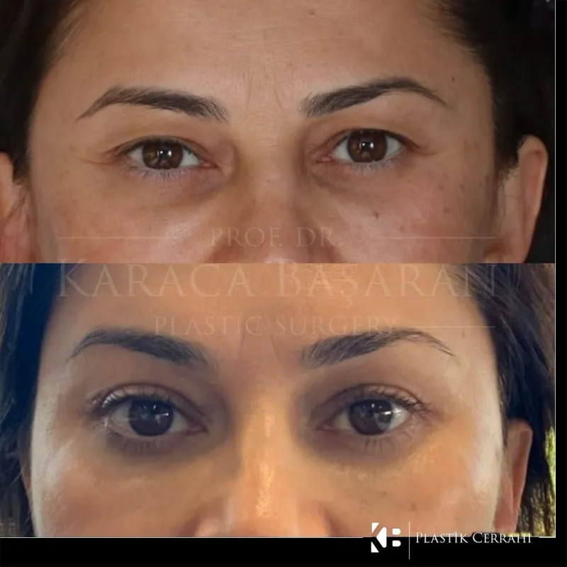 Before and after: Dr. Karaca Başaran