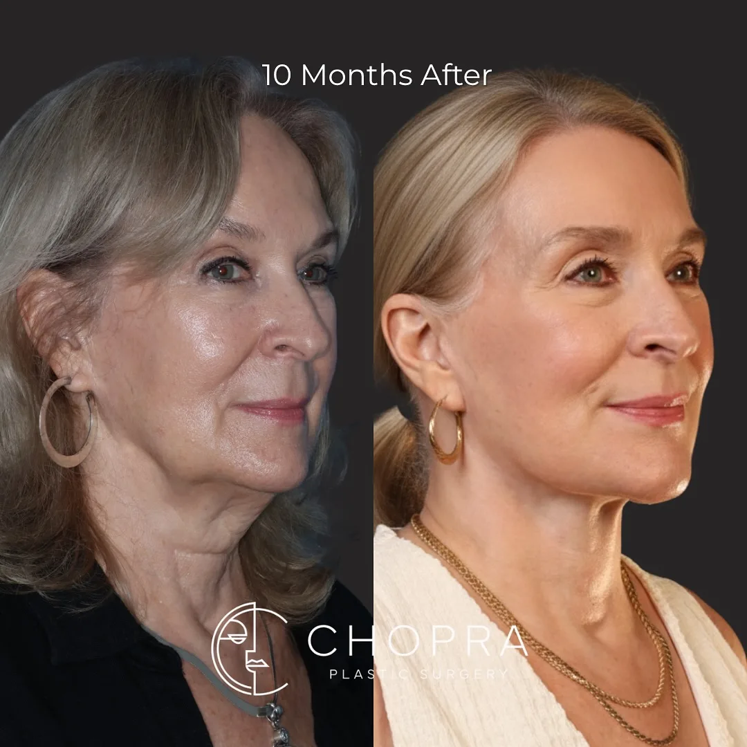 Before and after deep plane facelift — 58-year-old woman, three-quarter view, 10mo post-op by Dr. Karan Chopra