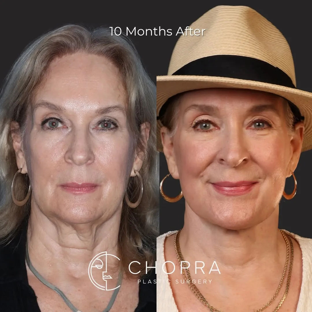 Before and after deep plane facelift — 58-year-old woman, frontal view, 10mo post-op by Dr. Karan Chopra