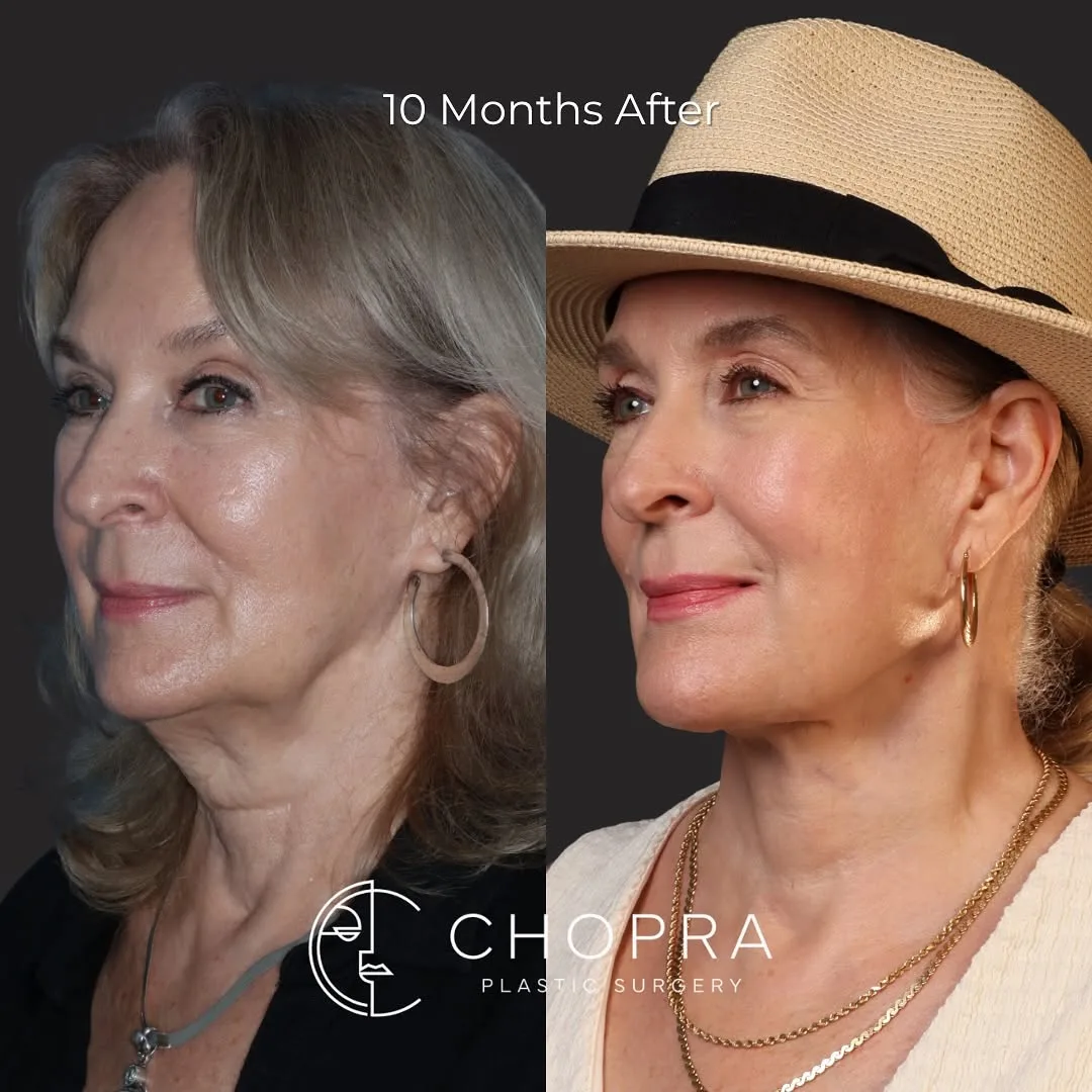 Before and after deep plane facelift — 58-year-old woman, three-quarter view, 10mo post-op by Dr. Karan Chopra