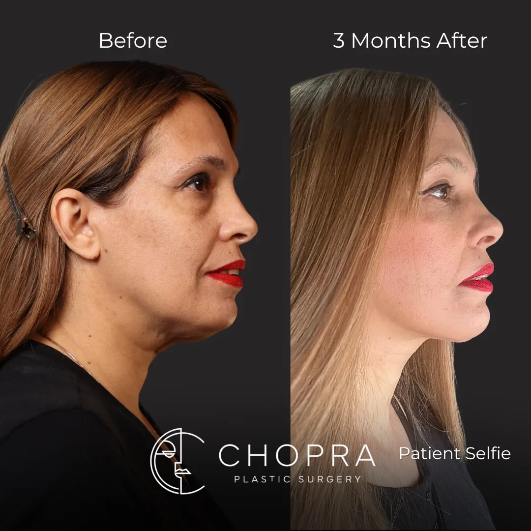 Before and after deep plane facelift — 58-year-old woman, right profile view, 3mo post-op by Dr. Karan Chopra