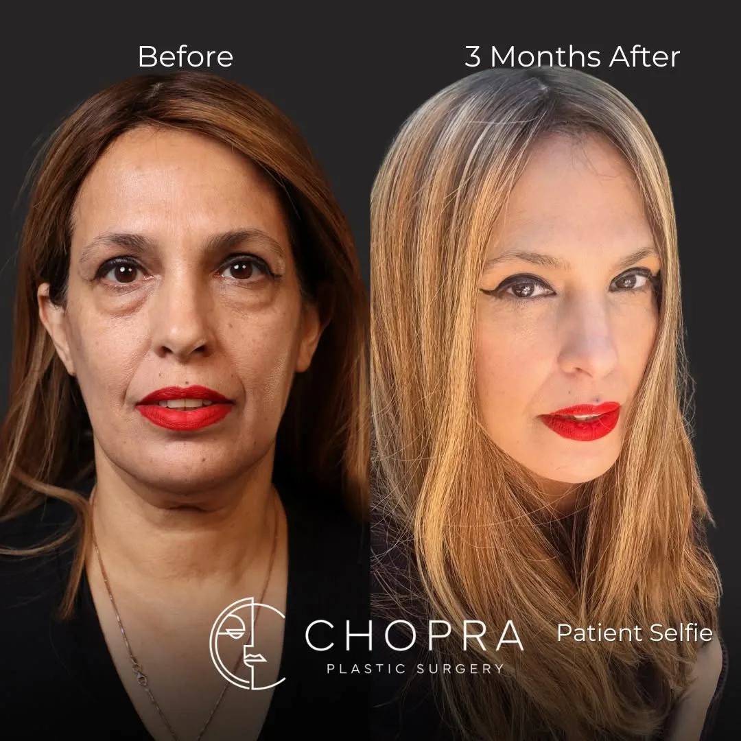 Before and after deep plane facelift — 48-year-old woman, oblique right view, 3mo post-op by Dr. Karan Chopra