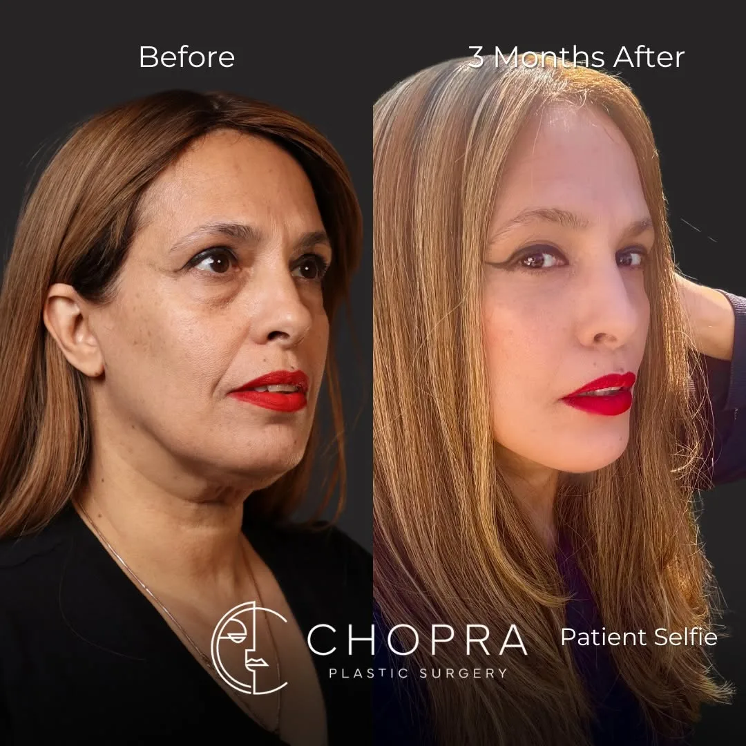 Before and after deep plane facelift — 52-year-old woman, oblique right view, 3mo post-op by Dr. Karan Chopra