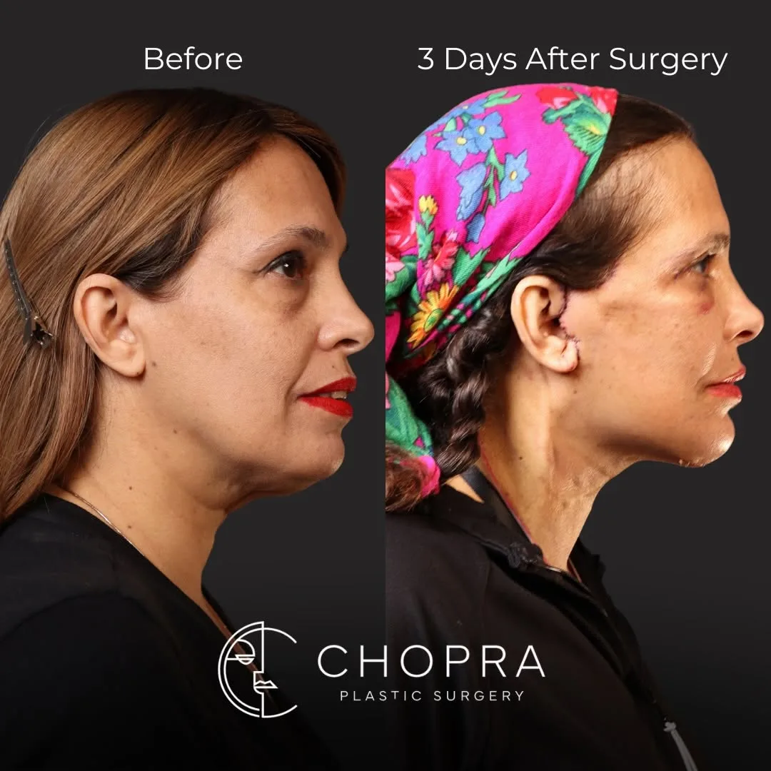 Before and after deep plane facelift — 45-year-old woman, right profile view, 1mo post-op by Dr. Karan Chopra