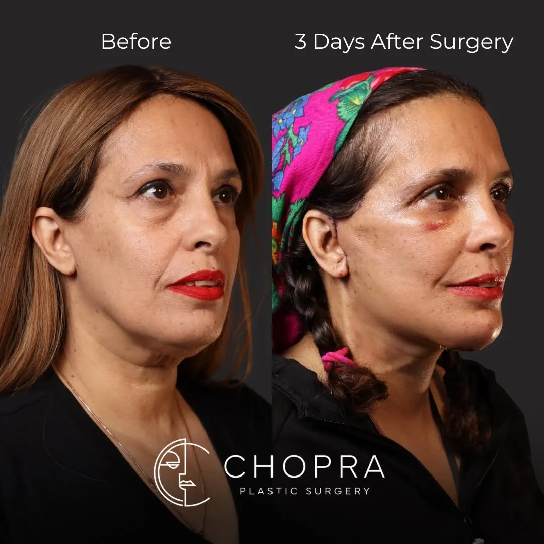 Before and after deep plane facelift — 52-year-old woman, oblique right view by Dr. Karan Chopra