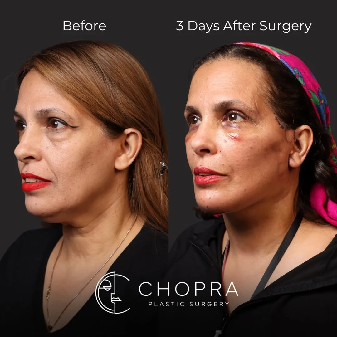 Before and after deep plane facelift — 58-year-old woman, left profile view, 1mo post-op by Dr. Karan Chopra